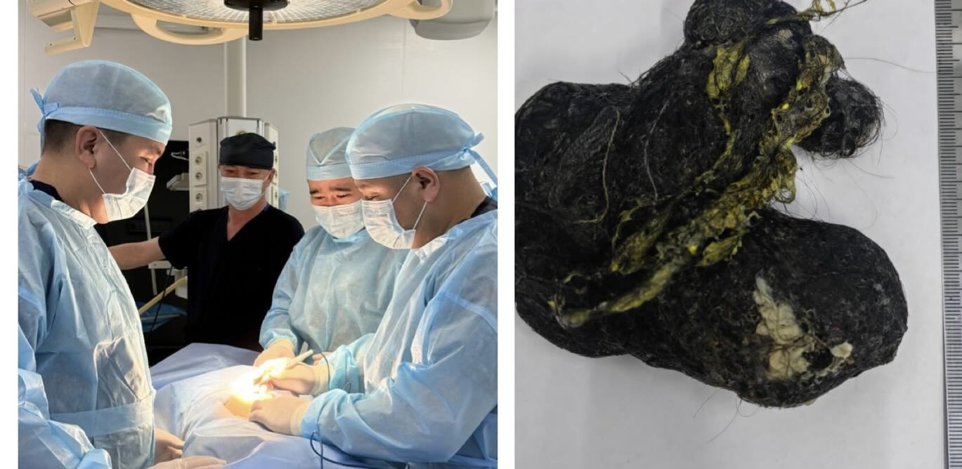 В Шымкенте у 8-летнего пациента выявили скопление волос в желудке