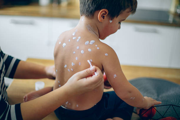 БҚО-да 11 жастағы баладан қызылша ауруының ең қауіпті түрі анықталды